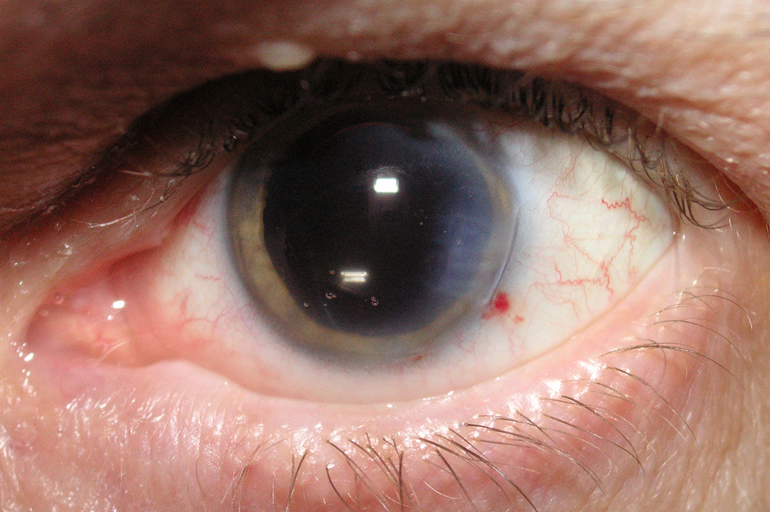 Cataract Surgery