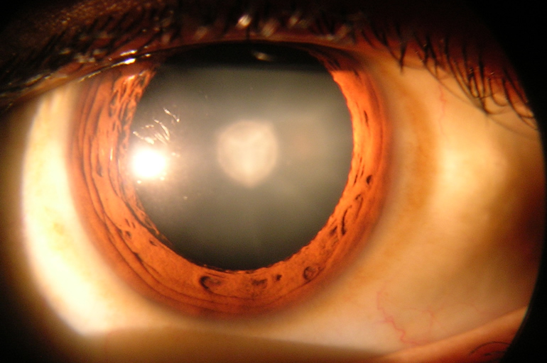 Cataract Treatment