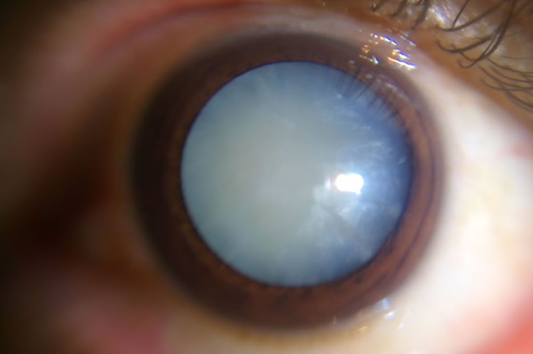 Intumescent Cataract