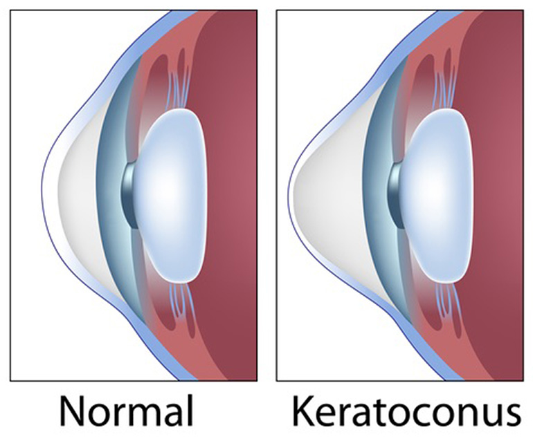 Keratoconus diagram