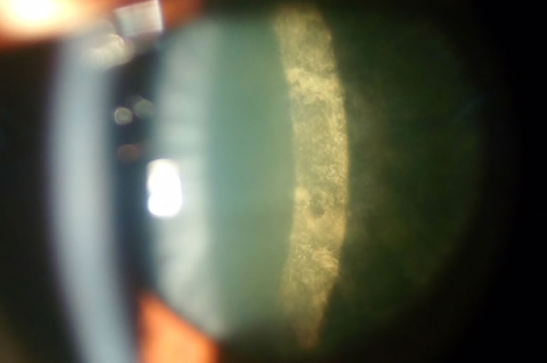 Posterior Subcapsular Cataract